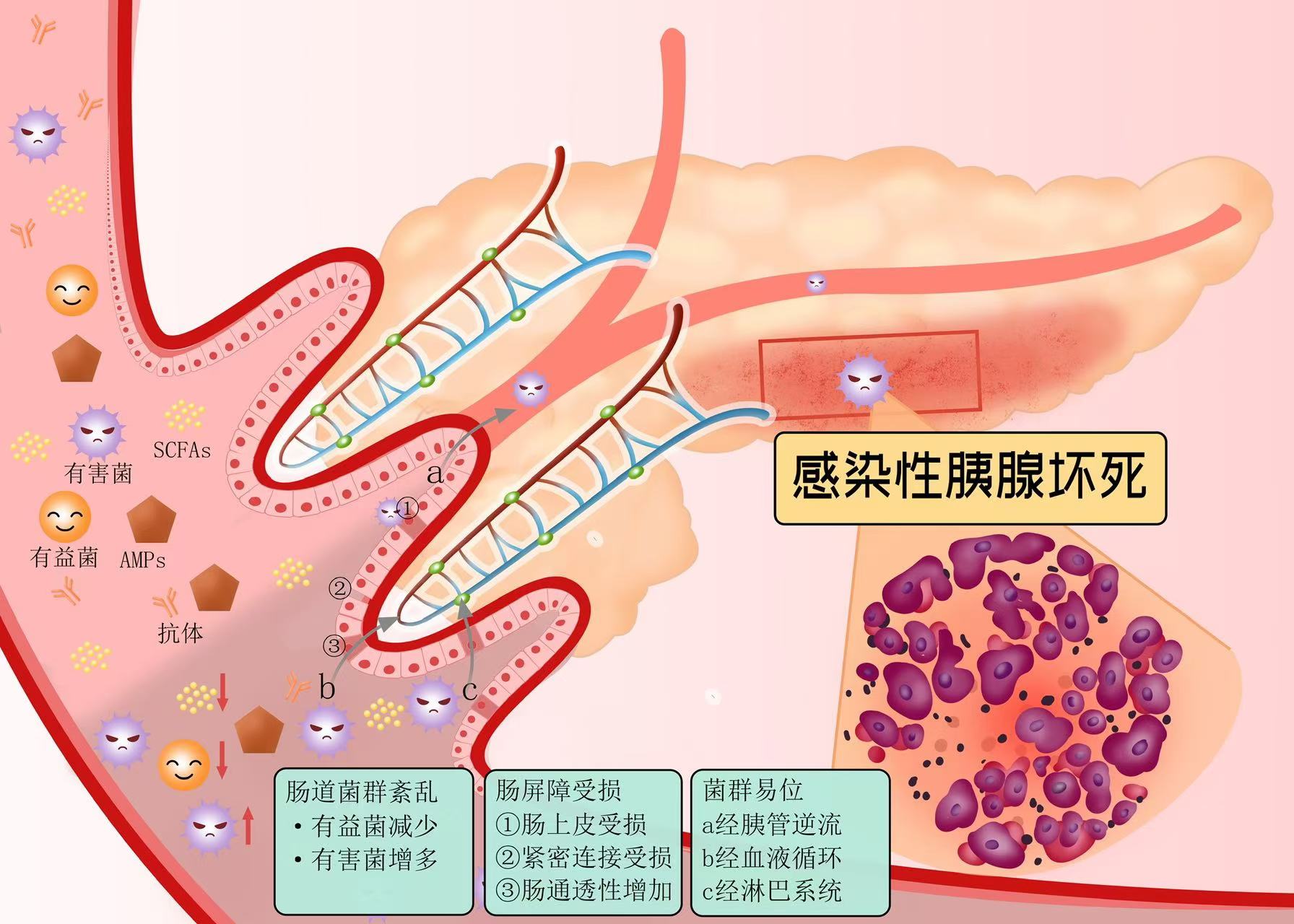 肠道菌群在感染性胰腺坏死中的作用_思维导图.jpg